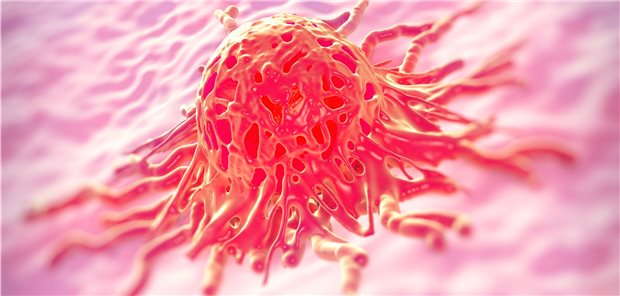 Rasterelektronenmiskroskop-Aufnahme einer Krebszelle, hier ein Zervix-Karzinom.