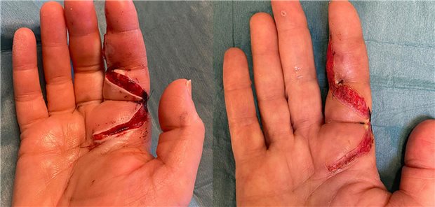 Rechte Hand der Patientin einen Tag (links) und zehn Tage (rechts) nach der Operation.