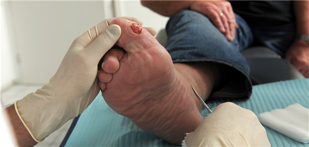 Experten raten bei Diabetischem Fuß zu Zweitmeinung per Telemedizin Regelmäßige Fußkontrolle: Professionelle Versorgung auch kleiner Wunden ist das A & O der DFS-Prävention.