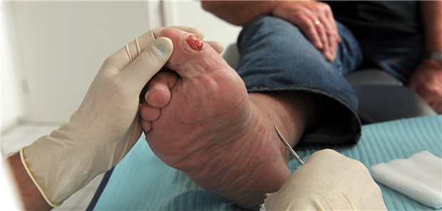 Regelmäßige Fußkontrolle ist bei Diabetikern essenziell. Sind erst einmal offene Wunden vorhanden, wird die Behandlung oft schwierig.