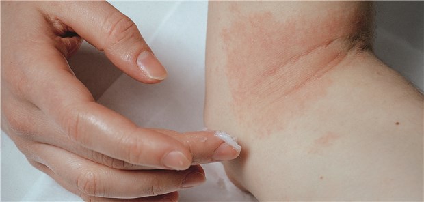 Regelmäßiges Cremen ist das A&O der Neurodermitistherapie. Wichtig ist auch die Auswahl der passenden Formulierung.