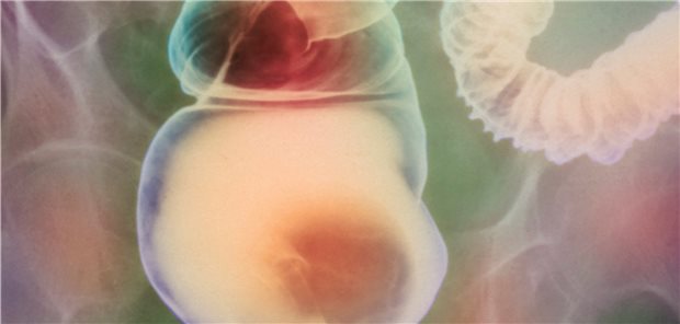 Reizdarmsyndrom: Das Rektum ist durch Obstipation oder eine Gasansammlung aufgebläht.