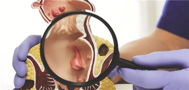 Rektum im Blick: In einer Studie wurde untersucht, welchen Nutzen eine Behandlung von analen intraepithelialen Läsionen bei Patienten mit HIV hat.