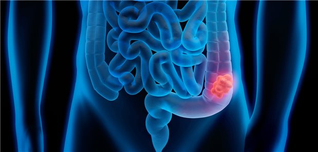 Rektumkarzinom: Bei der Standardtherapie mit totaler mesorektaler Exzision (TME) ist zumindest vorübergehend eine Stomaanlage erforderlich.
