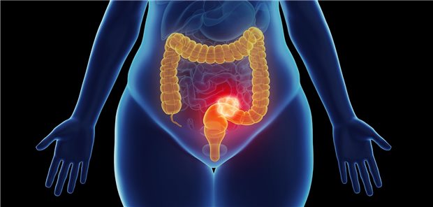 Rektumkarzinom: Der Erfolg einer multimodalen Behandlung wird durch die Reihenfolge der Behandlungsbausteine beeinflusst.