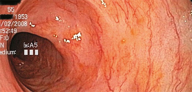 Remission einer Colitis ulcerosa im Bereich des Colon sigmoideum.