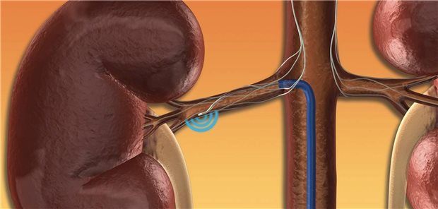 Renale Denervation: Mit einem Katheter werden Nervenbahnen in den Wänden der Nierenarterien verödet.