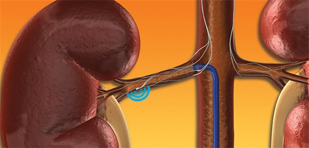 Renale Denervation enttäuscht erneut Renale Sympathikusdenervation mit einem Spezialkatheter in der Adventitia der Nierenarterien.