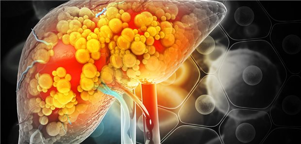 Resmetirom, C17H12Cl2N6O4, fördert die -Oxidation in den Hepatozyten und wirkt so der Leberverfettung entgegen.