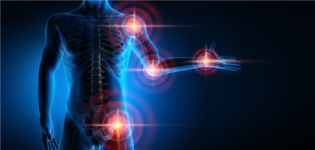 Rheumatische Gelenk-Entzündungen: Ist der Schmerz erst chronifiziert, ist eine interdisziplinäre Zusammenarbeit von Schmerztherapeuten, Physiotherapeuten, Psychologen, Ergotherapeuten, Sozialdienst und Patientenschulungen notwendig.