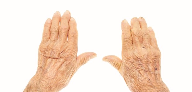 Rheumatoide Arthritis kann mit Biologicals effektiv behandelt werden. Eine neue Option sind Biosimilars.