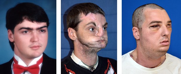 Gesichtstransplantation sprengt alle Grenzen Richard Lee Norris: Vor dem Unfall, danach und nach der Op.