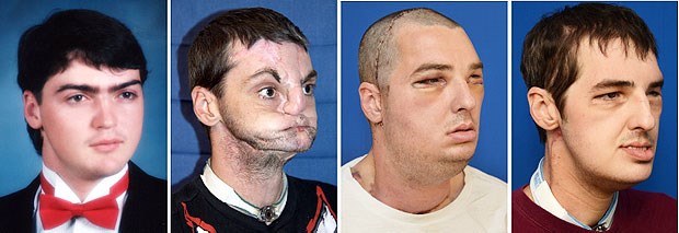US-Amerikaner hat wieder Freude am Leben Richard Lee Norris vor und nach dem Unfall und der Gesichtstransplantation.
