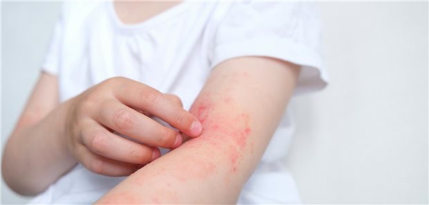Nahaufnahme eines Kind mit atopischer Dermatitis, dass sich an der atopischen Haut in seiner Armebeuge kratzt.