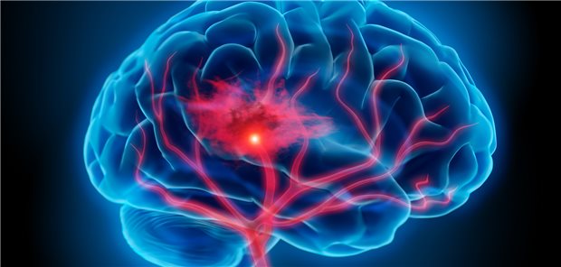 Risiko nach Schlaganfall: Einer aktuellen Analyse zufolge entwickeln Schlaganfallpatienten häufig gastrointestinale Tumoren, Bronchialkarzinome sowie hämatologische Tumoren.