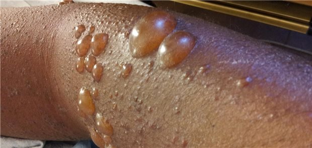 Bullöses Pemphigoid mit dickwandigen Blasen, die klare Flüssigkeit enthalten.