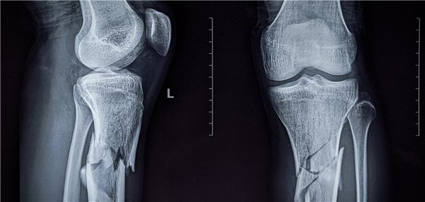 Ritchie Strain und Peter Giannoudis konstatieren, dass mit einer Rate von rund 5 Prozent das akute Kompartmentsyndrom (ACS) nach Tibiaschaftfrakturen noch immer ein erhebliches Problem darstelle.