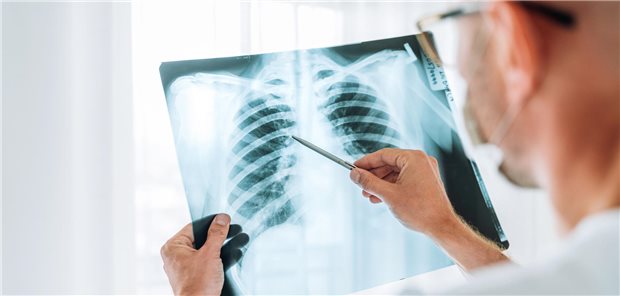 Röntgen-Thorax: Bei fortgeschrittenem nichtkleinzelligen Lungenkrebs beraten Teams des Netzwerks Genomische Medizin (nNGM) die Behandenden zur optimalen Therapie. (Symbolbild)