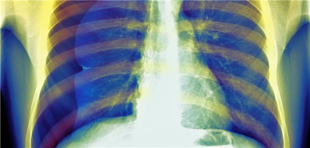 Röntgenaufnahme eines Patienten mit Pneumothorax: Bei akutem Pneumothorax stellt sich die Frage, wer von einer vollständig ambulanten, und wer von einer konservativen Therapie profitiert.