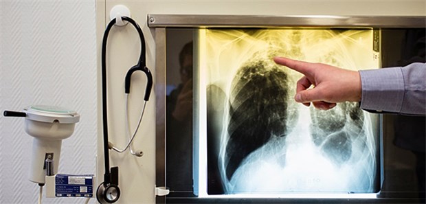 "TB muss auf die Prioritätenliste für Antibiotika" Röntgenaufnahme eines Tuberkulosepatienten.