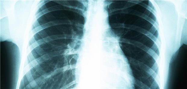 Röntgenaufnahme des Thorax zur Diagnose von Atemwegserkrankungen.