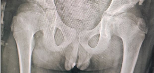 Röntgenbild des Jungen: Der Stein sitzt in der vorderen Harnröhre im Bereich des Penis fest.
