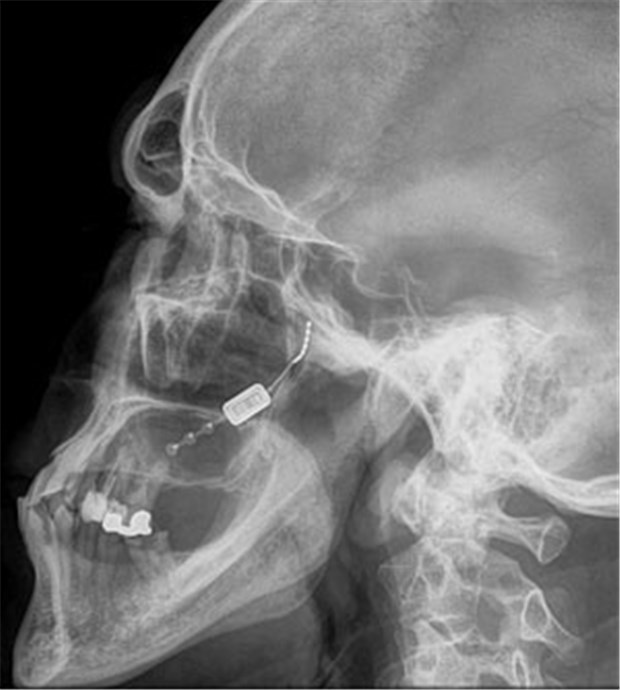 Mini-Stimulator schaltet Kopfschmerzen ab Röntgenbild des Kopfes nach Implantation des ATI-Neurostimulators in das Zahnfleisch des Oberkiefers.