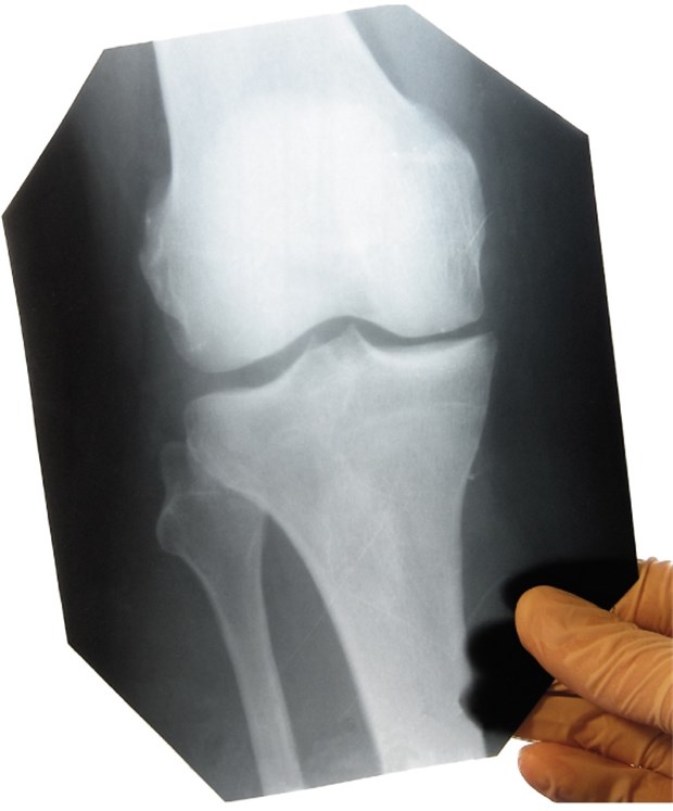 Glucosamin lindert Arthrose-Symptome Röntgenbild eines Kniegelenks: Bei Arthrose lassen sich die Symptome durch eine Behandlung mit Glucosamin oder Chondroitin lindern.