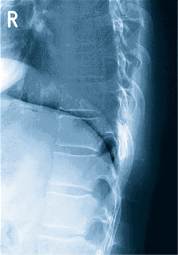 Integrierte Versorgung kann Compliance bei Osteoporose verbessern Röntgenbild eines Osteoporose Patienten.