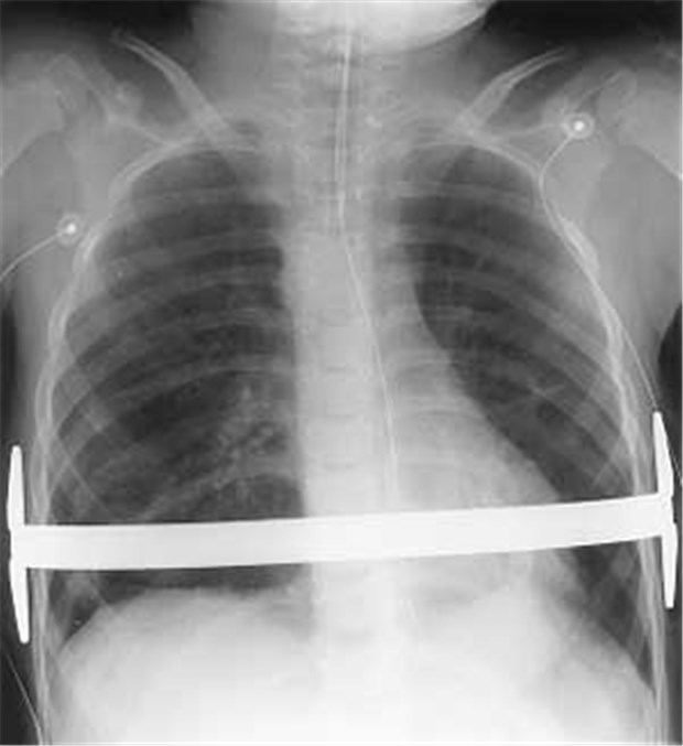 Bei Trichterbrust gibt's oft weitere Deformitäten Röntgenbild eines sechsjährigen Jungen mit Trichterbrust. Ein Metallbügel richtet das Brustbein auf und wird nach zwei Jahren wieder entfernt.