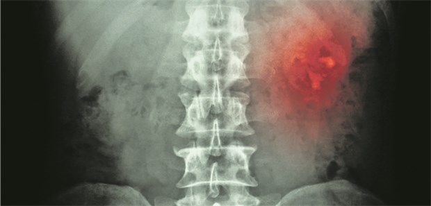 Für die Analyse reicht schon Nachturin Röntgenbild mit Nierensteinen: Lästiges Urinsammeln kann Betroffenen offenbar erspart werden.