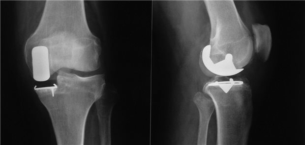 Röntgenbilder von unikompartimentellen Knieprothesen