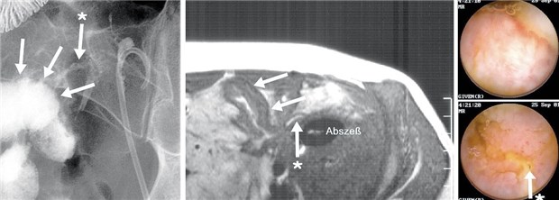 M. Crohn - oft genügen topische Steroide Röntgenkontrastbilder des Dünndarms (links): Entzündete Darmwand (weiße Pfeile) und ein Fistelgang (Pfeil mit Stern). Mitte: MRT-Bild derselben Region im Querschnitt. Rechts: Kapselendoskopiebilder des betroffenen Mukosa-Areals bei Morbus Crohn, unteres Bild: Fistelöffnung (Pfeil mit Stern).