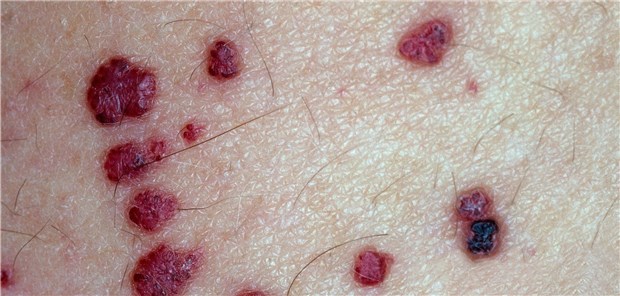 Rötlich-violette Papeln im „Badehosenbereich“ sind typisch für Morbus Fabry.