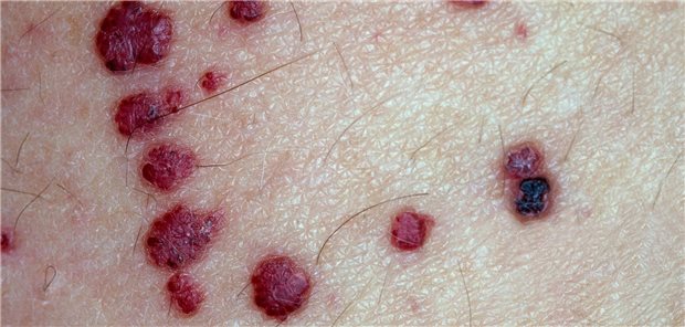 Rötlich-violette Papeln im „Badehosenbereich“ sind typisch für Morbus Fabry.