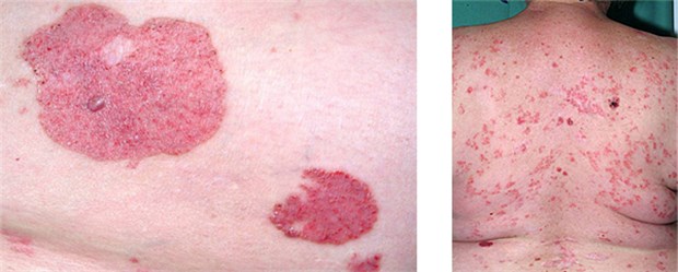 Rötliche Flecken als Folge der Arsen-Therapie gegen Psoriasis Rötliche Maculae bei einer Patientin mit Psoriasis, die früher mit Arsen therapiert wurde.