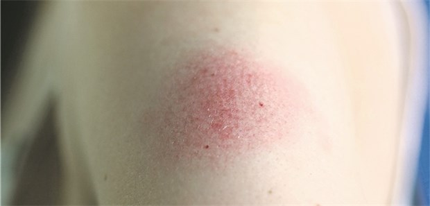 EuGH stärkt Patienten-Position Rötung an der Einstichstelle – kann nach einer Impfung schon mal vorkommen. Aber eine MS infolge einer Impfung gegen Hepatitis B? Der EuGH hat jetzt einen entsprechenden Produktfehler nicht ausschließen wollen.