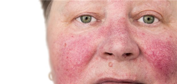 Rosazea: Nicht selten stellt die Diagnose der Augenarzt.