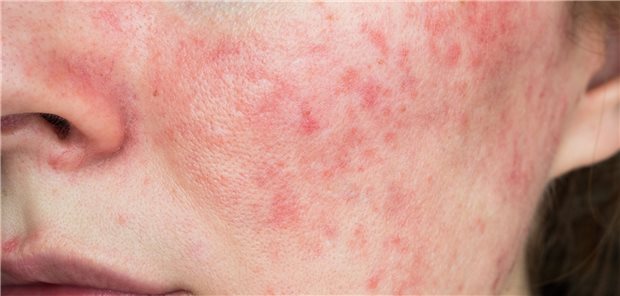 Rosazea: entzündliche Hauterkrankung, die nicht nur lokal auf das Gesicht begrenzt ist?
