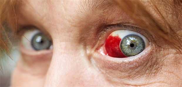 Rotes Auge: Ein subkonjunktivales Hämatom gehört zu den eher harmlosen Ursachen.