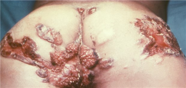 Rückansicht eines Patienten mit Kokzidioidomykose: Die Erkrankung wird durch die Pilze Coccidioides immitis und C. posadasii verursacht.