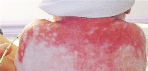 Rücken eines Kleinkindes mit AEC-Syndrom.