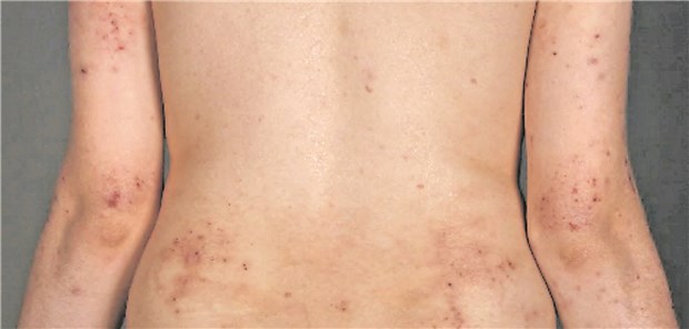IL-17-Antikörper als neuer Ansatz gegen Neurodermitis? Rücken eines Neurodermitis-Patienten: Der Hefepilz Malassezia kann Forschern zufolge eine Überreaktion des Immunsystem hervorrufen und so eine atopische Dermatitis begünstigen. Dermatologische Klinik, Universitätsspital Zürich