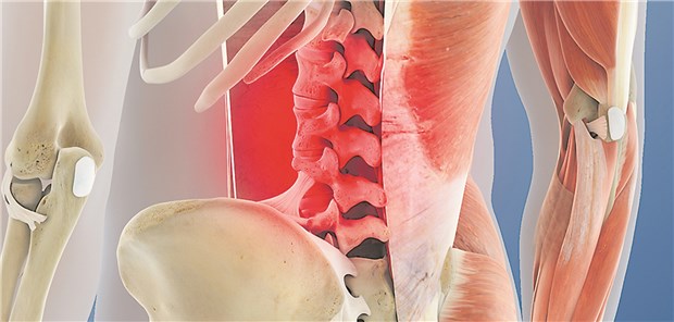 Was Calcitonin gegen Kreuzweh ausrichten kann Rückenschmerz: 50 Prozent der Patienten unter Calcitonin erreichten nach vier Wochen eine klinisch relevante Schmerzreduktion.