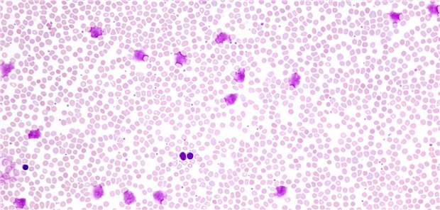 Rund 0,6 Prozent der Menschen entwickeln im Lauf ihres Lebens eine CLL. Charakteristisch für die Erkrankung ist eine Lymphozytose.