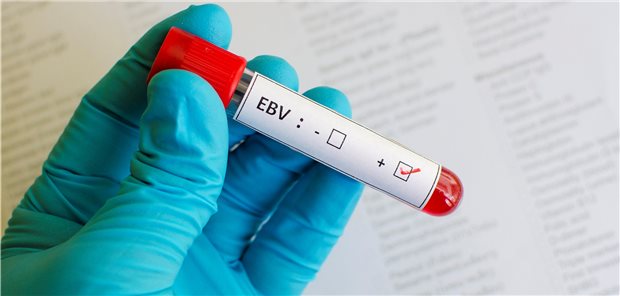 Rund 95 Prozent aller Menschen infizieren sich im Laufe ihres Lebens mit dem Epstein-Barr-Virus.