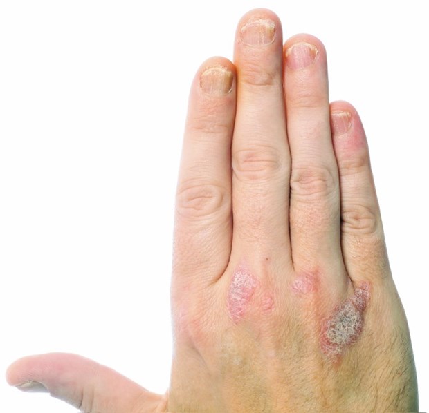 Nagelpsoriasis - störend und schmerzhaft Rund die Hälfte der Patienten mit Nagelpsoriasis fühlt sich im Alltag eingeschränkt, fast ebenso viele auch im Beruf. ©Christine Langer-Püschel/Fotolia.com