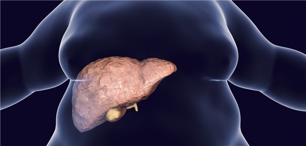 Jeder vierte Europäer hat eine Fettlebererkrankung.