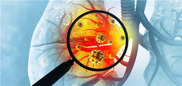 SARS-CoV-2-Virus in der Lunge: Auf die Entwicklung eines Asthmas bei Kindern und Jugendlichen hat es, einer Studie zufolge, wohl keinen Einfluss.