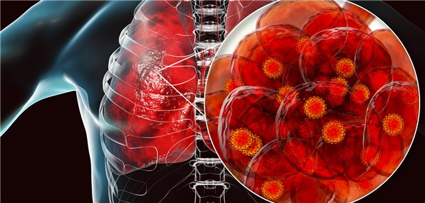 SARS-CoV-2 in der Lunge: Weiterhin wird geforscht, bei welchen Grunderkrankungen das Risiko für eine COVID-19 erhöht ist.